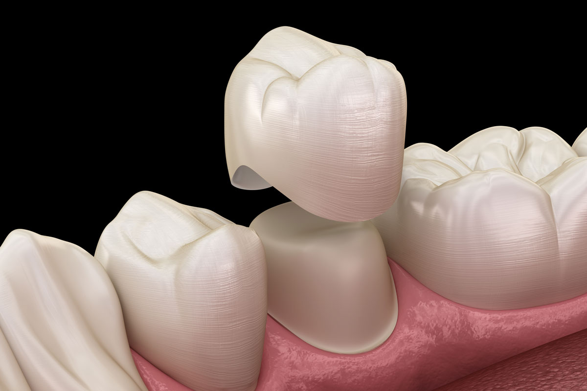 Render 3D Corona dentale per coprire un dente gravemente danneggiato