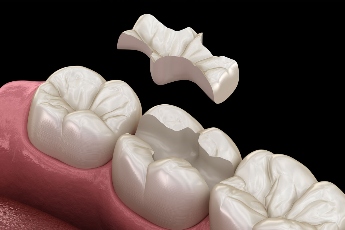 Render 3D di un Intarsio per curare una carie dentale estesa