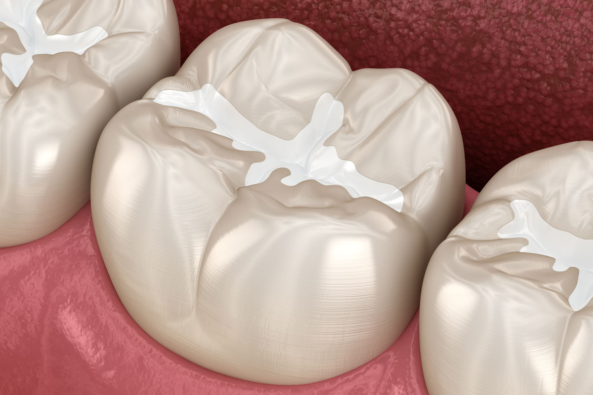 Render 3D Otturazione in composito dente