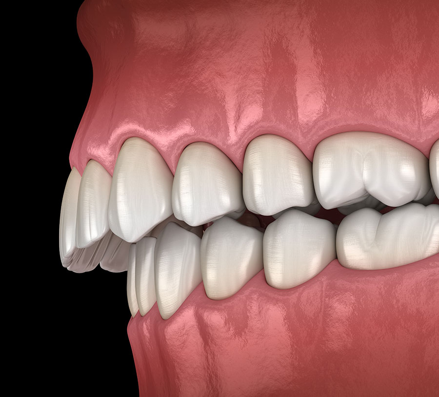 Render 3D Malocclusioni